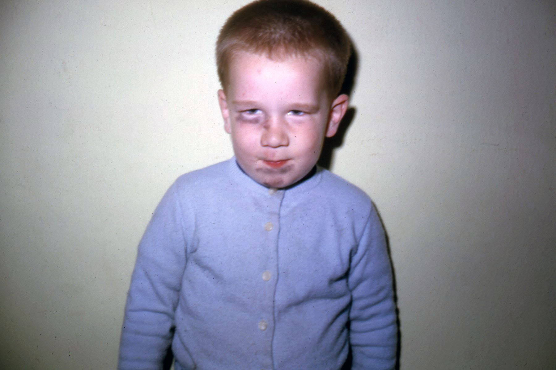 I'm not sure anyone remembers how my brother got this black eye, but this shot shows that Dad always had the Retina ready at a moment's notice.  Mid-1960's Kodachrome.